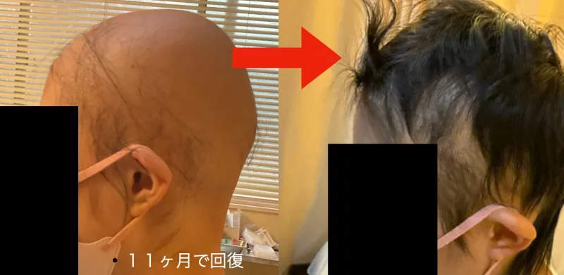 円形脱毛症の治療・回復例02