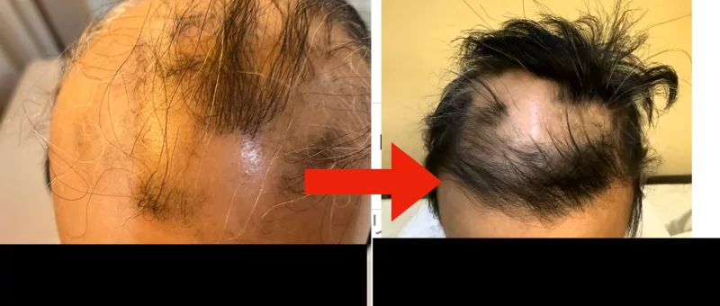円形脱毛症の治療・回復例03