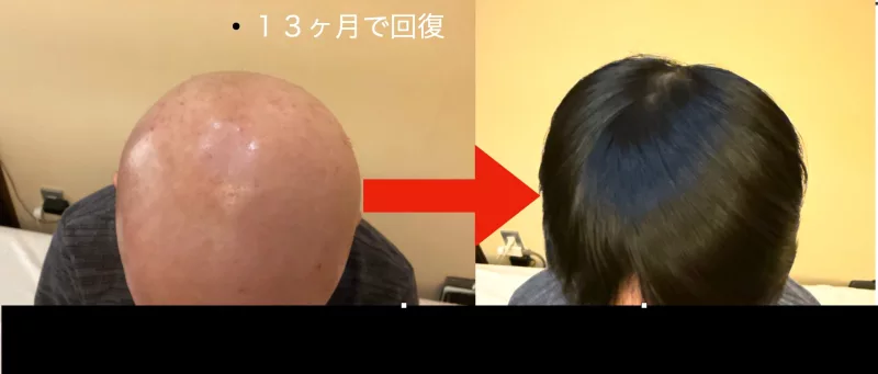 円形脱毛症の治療・回復例04