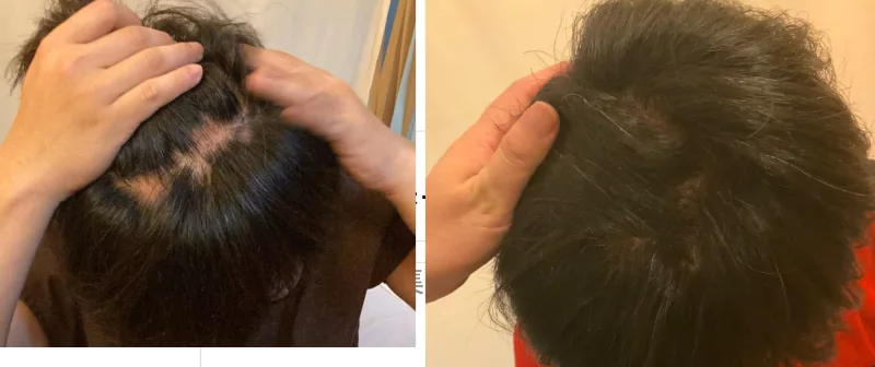 円形脱毛症の治療・回復例05