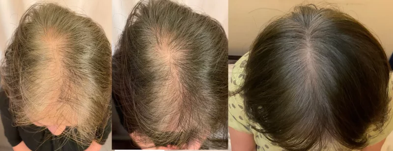 円形脱毛症の治療・回復例07